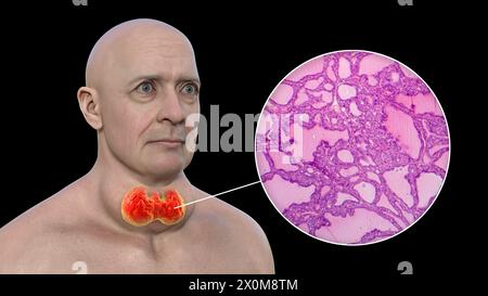 Illustrazione 3D di un uomo con gozzo tossico (ghiandola tiroidea allargata, base del collo) e un primo piano del tessuto tiroideo interessato. Un gozzo è considerato tossico quando l'ingrossamento della ghiandola tiroidea produce anche un eccesso di ormone tiroideo. Foto Stock