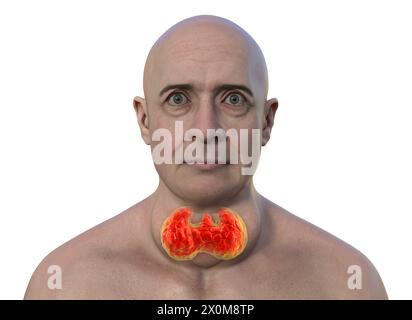 Illustrazione 3D di un uomo con una ghiandola tiroidea allargata (gozzo, base del collo) e sporgenza anormale degli occhi (esoftalmo). Questi sono due sintomi di una ghiandola tiroidea iperattiva, nota come ipertiroidismo. Foto Stock