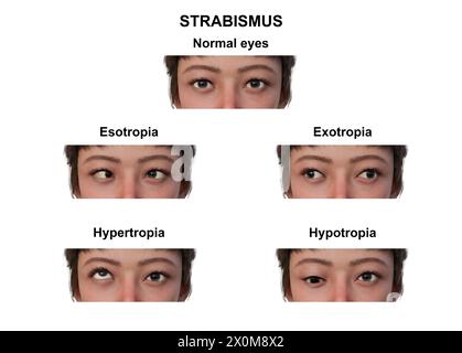 Illustrazione di una donna con vari tipi di strabismo: Esotropia, esotropia, ipertropia e ipotropia. Foto Stock
