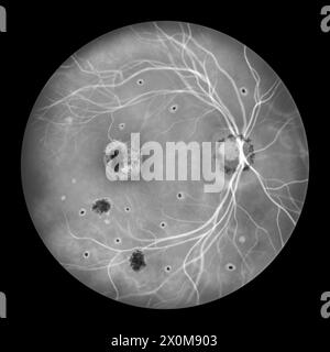 Illustrazione di una retina influenzata da presunta sindrome da istoplasmosi oculare come visto nell'angiografia fluoresceina. La retina mostra neovascolarizzazione coroidale, macchie di histo, cicatrici fibrotiche e pigmentate, cicatrici peripapillari. Foto Stock