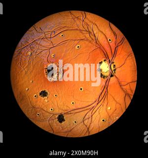 Illustrazione di una retina influenzata da presunta sindrome da istoplasmosi oculare, come osservato in oftalmoscopia. La retina mostra neovascolarizzazione coroidale, macchie di histo, cicatrici fibrotiche e pigmentate e cicatrici peripapillari. Foto Stock