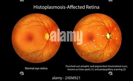 Illustrazione di una retina influenzata da presunta sindrome da istoplasmosi oculare, come osservato in oftalmoscopia. La retina è caratterizzata da cicatrici corioretiniche perforate e pigmentate (macchie di histo) e cicatrici peripapillari. Foto Stock