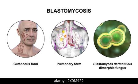 Illustrazione 3D che mostra due presentazioni cliniche della blastomicosi e una vista ravvicinata dei funghi Blastomyces dermatitidis. La blastomicosi è un'infezione fungina che può verificarsi quando le spore di Blastomyces dermatitidis vengono inalate. L'infezione colpisce principalmente i polmoni (polmonari), con alcuni pazienti che sviluppano anche sintomi cutanei (cutanei) come lesioni. Foto Stock