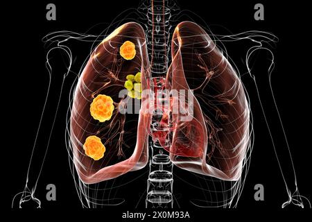 Illustrazione 3D della blastomicosi polmonare e primo piano del fungo causale, Blastomyces dermatitidis. La blastomicosi è spesso asintomatica, ma può causare lesioni polmonari (verde) e ingrossamento dei linfonodi bronchiali (giallo). Foto Stock