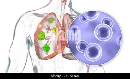 Illustrazione 3D della blastomicosi polmonare e primo piano del fungo causale, Blastomyces dermatitidis. La blastomicosi è spesso asintomatica, ma può causare lesioni polmonari (verde) e ingrossamento dei linfonodi bronchiali (giallo). Foto Stock