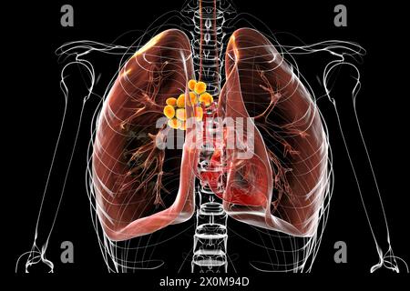 Illustrazione 3D dei polmoni affetti da linfoadenopatia mediastinica. Si tratta di un ingrossamento dei linfonodi che si trovano all'interno della cavità toracica centrale (torace). Ci sono molteplici cause potenziali di linfoadenopatia mediastinica, tra cui infezione batterica, cancro e malattie genetiche. Foto Stock