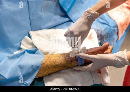 L'infermiere chiude l'accesso vascolare del paziente dopo l'intervento chirurgico. Un infermiere applica bende vascolari in sala operatoria. Cure mediche da mantenere Foto Stock