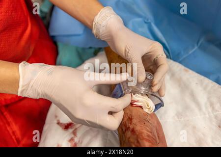 L'infermiere chiude l'accesso vascolare del paziente dopo l'intervento chirurgico. Un infermiere applica bende vascolari in sala operatoria. Cure mediche da mantenere Foto Stock