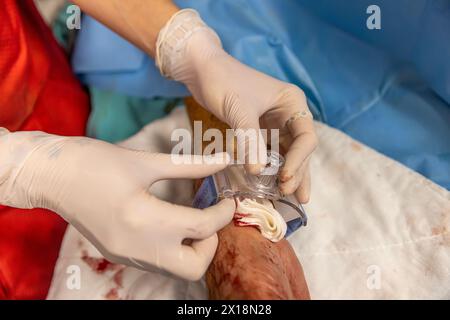 L'infermiere chiude l'accesso vascolare del paziente dopo l'intervento chirurgico. Un infermiere applica bende vascolari in sala operatoria. Cure mediche da mantenere Foto Stock