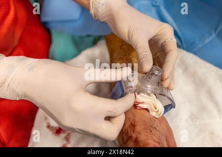 L'infermiere chiude l'accesso vascolare del paziente dopo l'intervento chirurgico. Un infermiere applica bende vascolari in sala operatoria. Cure mediche da mantenere Foto Stock