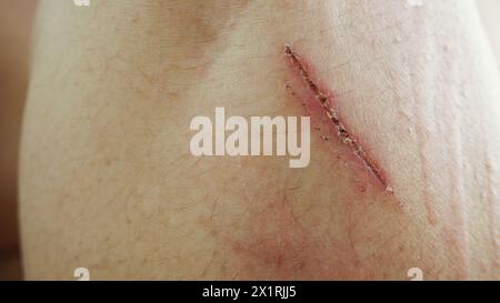 ferita con schegge sul ginocchio della donna Foto Stock