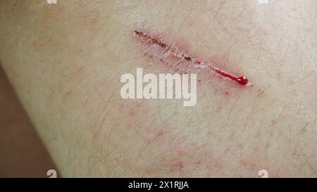 ferita con schegge sul ginocchio della donna Foto Stock