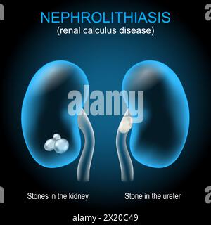Malattia da calcoli renali. Malattia del calcolo renale. Nefrolitiasi o urolitiasi. Calcolo renale che si sviluppa nelle vie urinarie. Illustrazione vettoriale Illustrazione Vettoriale