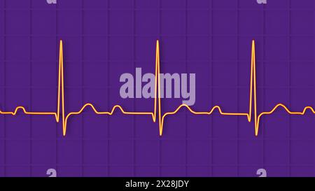 ECG con blocco AV di primo grado, illustrazione Foto Stock