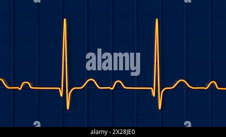 ECG con blocco AV di primo grado, illustrazione Foto Stock