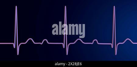 ECG con blocco AV di primo grado, illustrazione Foto Stock