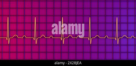 ECG con blocco AV di primo grado, illustrazione Foto Stock