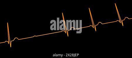 ECG con blocco AV Mobitz 2 di secondo grado, illustrazione Foto Stock