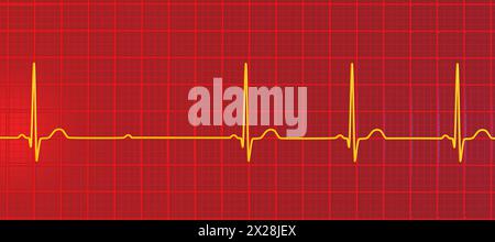 ECG con blocco AV Mobitz 2 di secondo grado, illustrazione Foto Stock