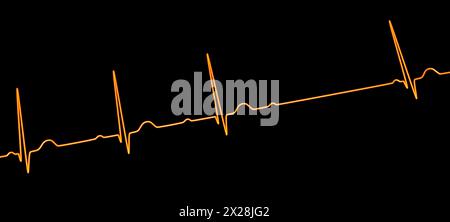 ECG con blocco AV di secondo grado, illustrazione Foto Stock