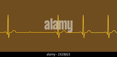 ECG con blocco AV Mobitz 2 di secondo grado, illustrazione Foto Stock