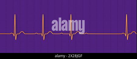 ECG con blocco AV di secondo grado, illustrazione Foto Stock