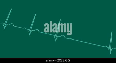 ECG con blocco AV di secondo grado, illustrazione Foto Stock