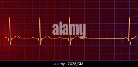 ECG con blocco AV di secondo grado, illustrazione Foto Stock