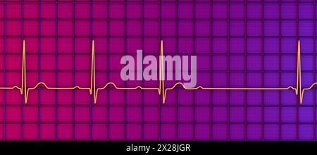 ECG con blocco AV di secondo grado, illustrazione Foto Stock