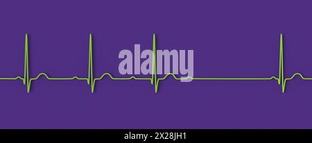 ECG con blocco AV di secondo grado, illustrazione Foto Stock