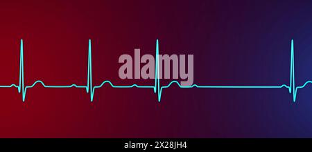 ECG con blocco AV di secondo grado, illustrazione Foto Stock