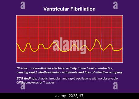 ECG in fibrillazione ventricolare, illustrazione Foto Stock