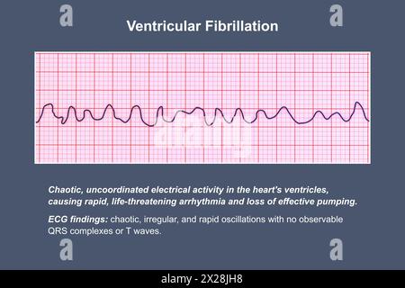 ECG in fibrillazione ventricolare, illustrazione Foto Stock