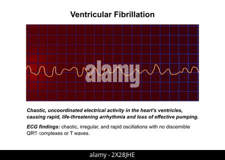 ECG in fibrillazione ventricolare, illustrazione Foto Stock