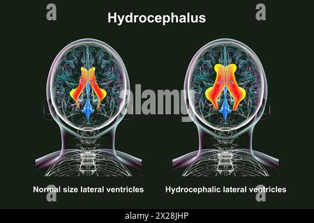 Ventricoli laterali ingranditi e normali, illustrazione Foto Stock
