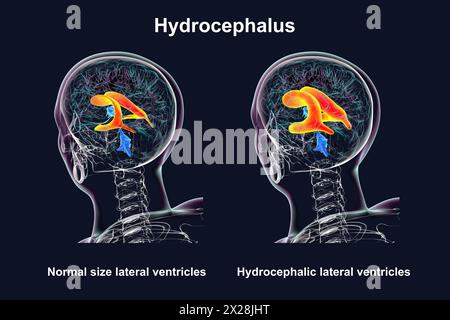 Ventricoli laterali ingranditi e normali, illustrazione Foto Stock