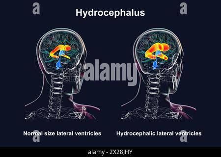 Ventricoli laterali ingranditi e normali, illustrazione Foto Stock