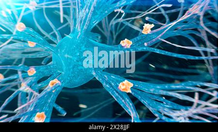 Placche amiloidi sulle cellule nervose, illustrazione Foto Stock