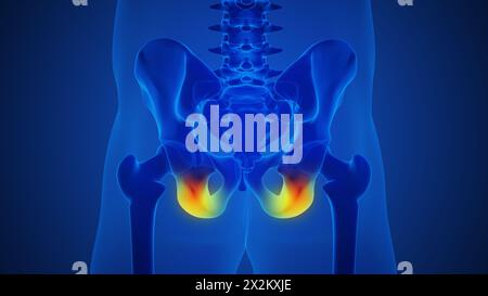 Scheletro umano e doloroso dolore articolare dell'anca Foto Stock