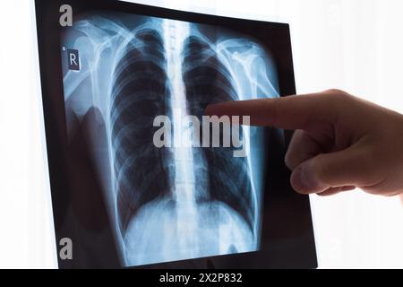 Concetto di radiografia polmonare. Medico di radiologia che esamina la pellicola radiografica toracica del paziente cancro polmonare o polmonite. Virus e batteri hanno infettato l'umano Foto Stock