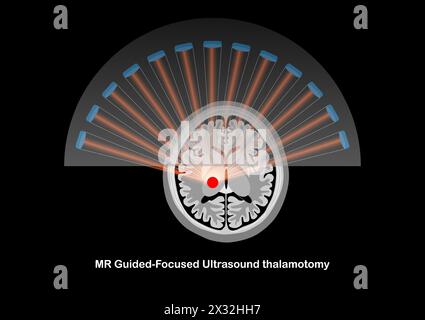 Talamotomia ecografica focalizzata con guida RM per il trattamento del tremore nel morbo di Parkinson. Illustrazione Vettoriale