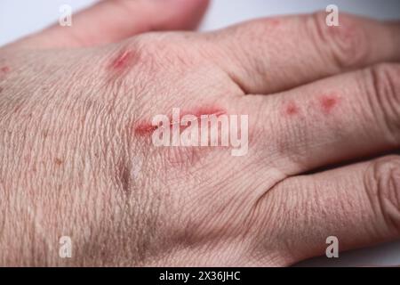 Graffi sulla pelle in primo piano. Una ferita causata da un gatto. Messa a fuoco selettiva Foto Stock