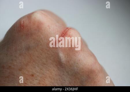 Primo piano di una ferita graffiata sulla mano di una donna matura. Messa a fuoco selettiva Foto Stock