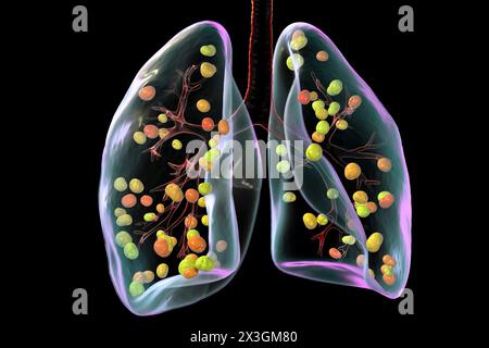 Illustrazione dell'istoplasmosi polmonare, un'infezione fungina causata dall'Histoplasma capsulatum, che mostra piccoli noduli sparsi in tutti i polmoni. Foto Stock