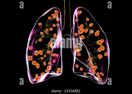 Illustrazione dell'istoplasmosi polmonare, un'infezione fungina causata dall'Histoplasma capsulatum, che mostra piccoli noduli sparsi in tutti i polmoni. Foto Stock