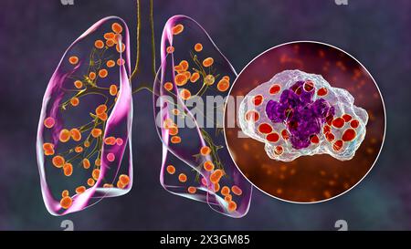 Illustrazione dell'istoplasmosi polmonare, un'infezione fungina causata dall'Histoplasma capsulatum, che mostra piccoli noduli sparsi nei polmoni e vista ravvicinata dei lieviti istoplasmatici. Foto Stock