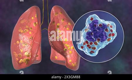 Illustrazione dell'istoplasmosi polmonare, un'infezione fungina causata dall'Histoplasma capsulatum, che mostra piccoli noduli sparsi nei polmoni e vista ravvicinata dei lieviti istoplasmatici. Foto Stock