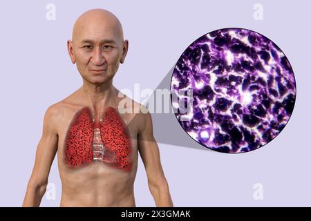 Illustrazione di un uomo con i polmoni del fumatore, insieme a un'immagine micrografica dei polmoni colpiti dal fumo. Foto Stock
