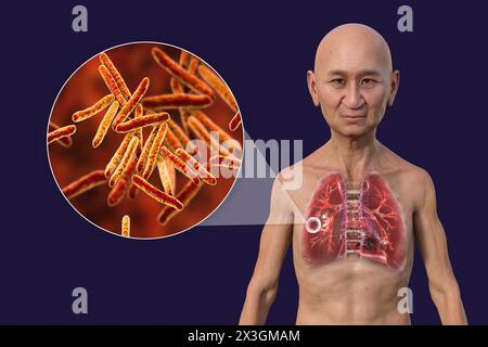 Illustrazione di un uomo con polmoni affetti da tubercolosi cavernosa e vista ravvicinata dei batteri Mycobacterium tuberculosis. Foto Stock