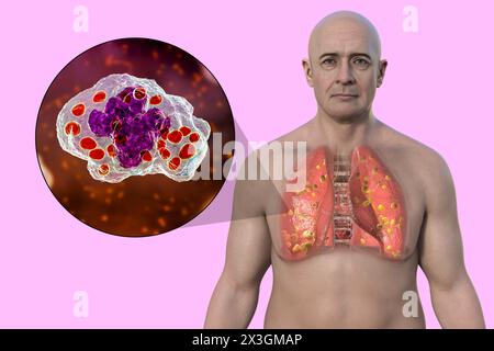 Illustrazione di un uomo con istoplasmosi polmonare, un'infezione fungina causata dall'Histoplasma capsulatum, che mostra piccoli noduli sparsi in tutti i polmoni. Foto Stock